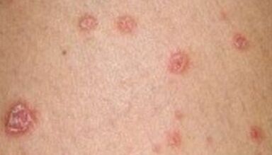 Foto von Psoriasis im Anfangsstadium