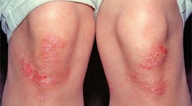 Hauptmanifestationen der Psoriasis