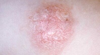 Wie erkennt man Psoriasis frühzeitig