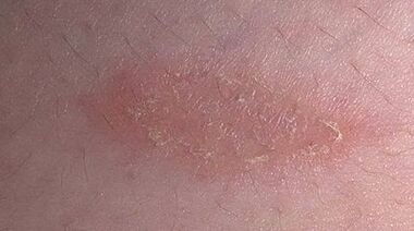 wie und womit man Psoriasis behandelt