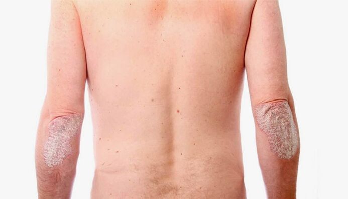 Volksheilmittel zur Behandlung von Psoriasis