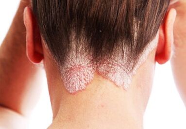 Psoriasis am Kopf