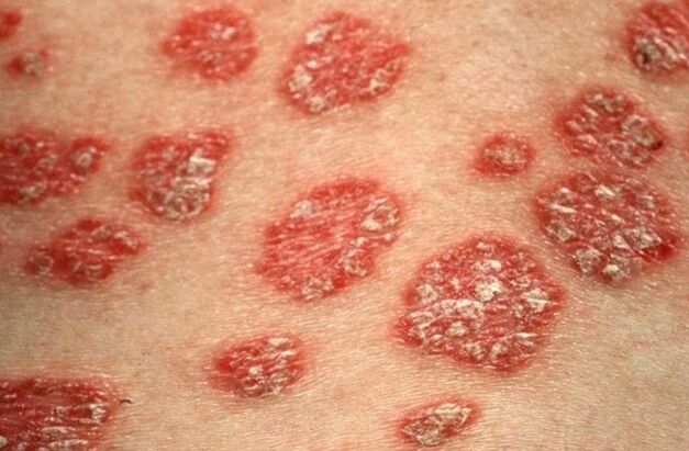 Psoriasis Papeln