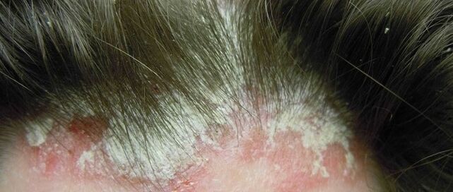 Psoriasis am Kopf