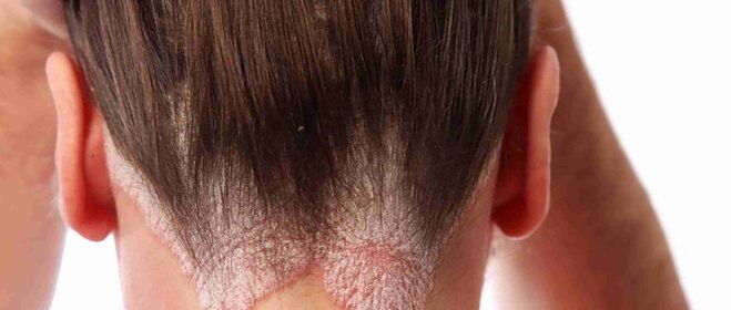 Psoriasis des Kopfes
