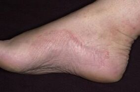 Psoriasis des Fußes