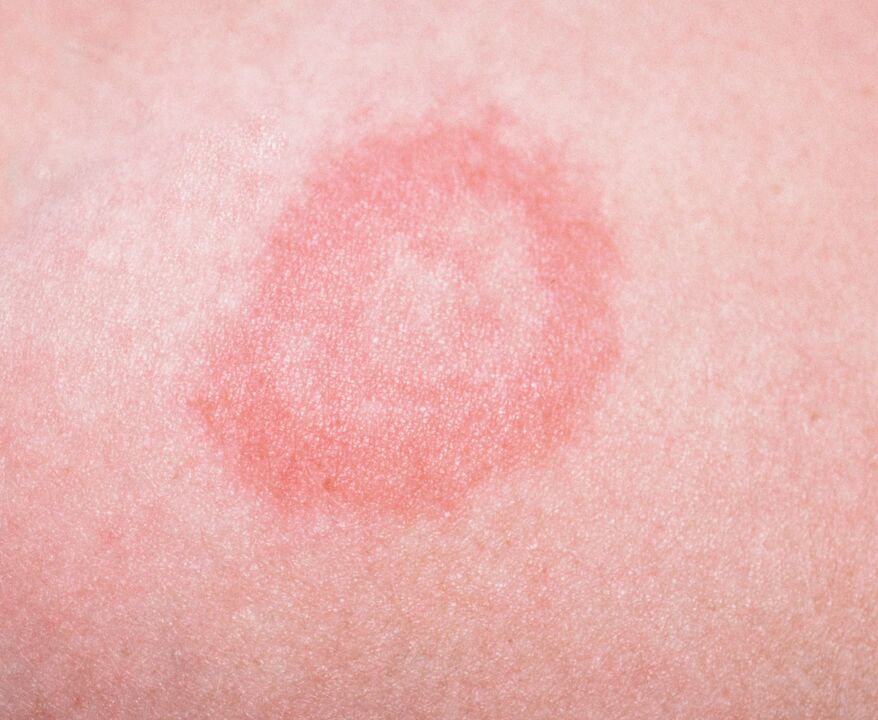 Psoriasis ist