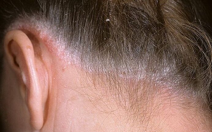 Psoriasis im Haar