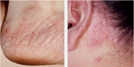Arten von Psoriasis