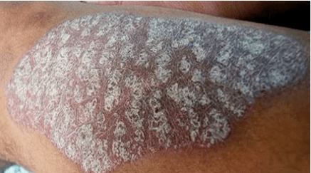 Pathogenese der Psoriasis