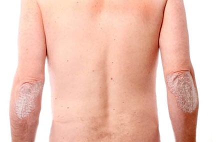 Allgemeine Symptome von Psoriasis