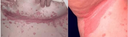 Atypische Form der Psoriasis
