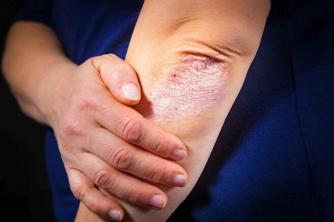 Psoriasis zu Hause