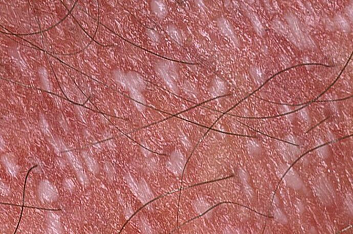 Pustelpsoriasis