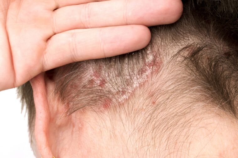 Verschlimmerung der Psoriasis am Kopf