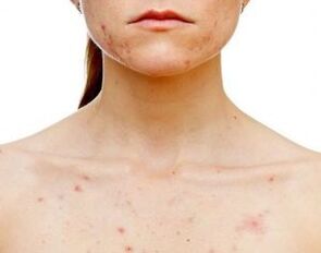 An welchen Körperstellen tritt Psoriasis auf