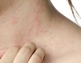 Hauptsymptome der Psoriasis