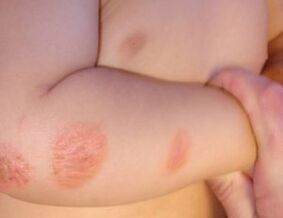 Symptome einer Psoriasis bei Kindern