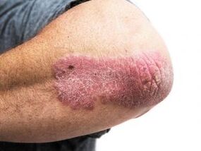 Plaque-Psoriasis am Ellenbogen