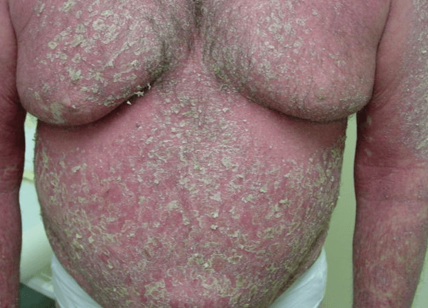 Psoriasis-Erythrodermie am Körper