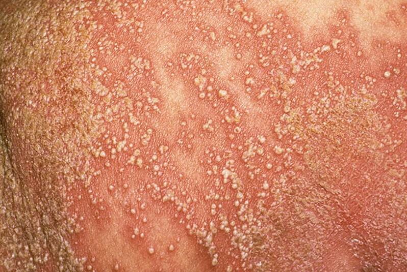 Pustelpsoriasis