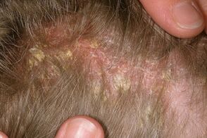 Psoriasis am Kopf