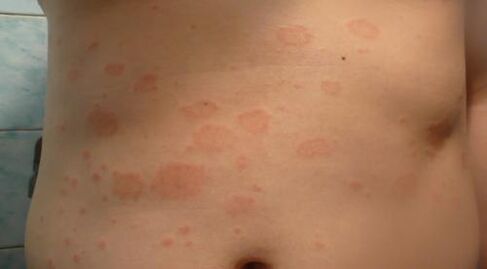Psoriasis am Körper