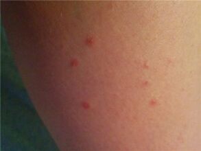 Psoriasis auf der Haut
