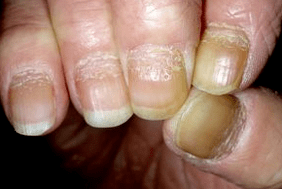 Nagelpsoriasis