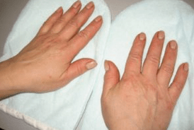 Psoriasis der Fingernägel